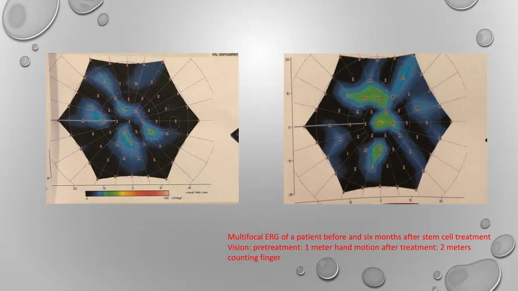 multifocal erg of a patient before and six months