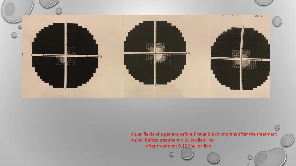 visual fields of a patient before first and sixth
