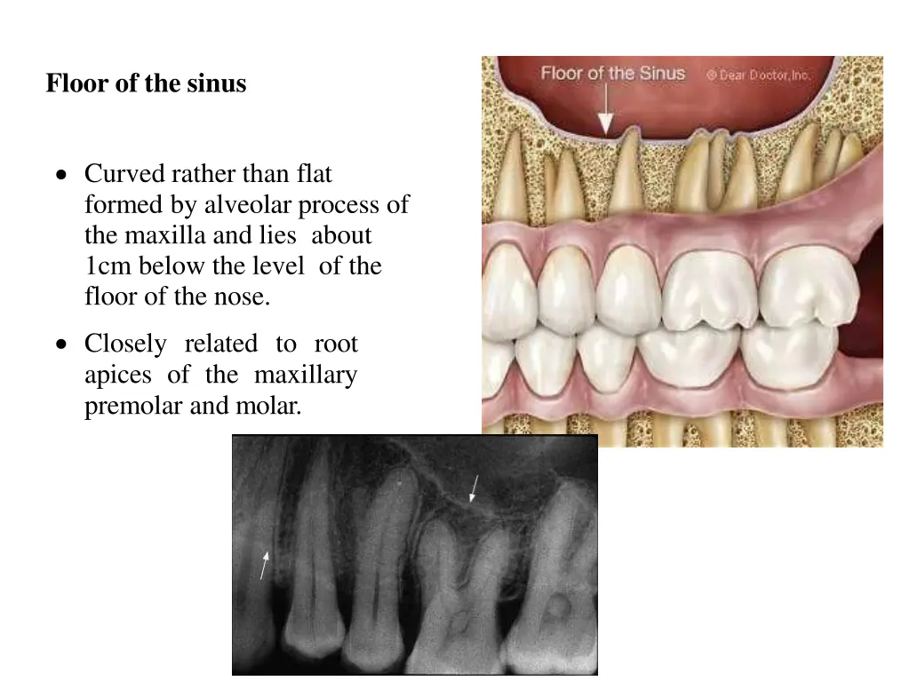 floor of the sinus