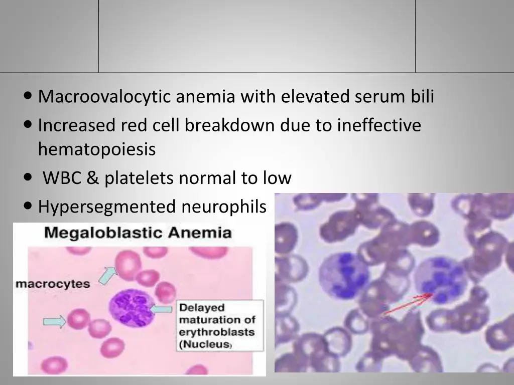 macroovalocytic anemia with elevated serum bili
