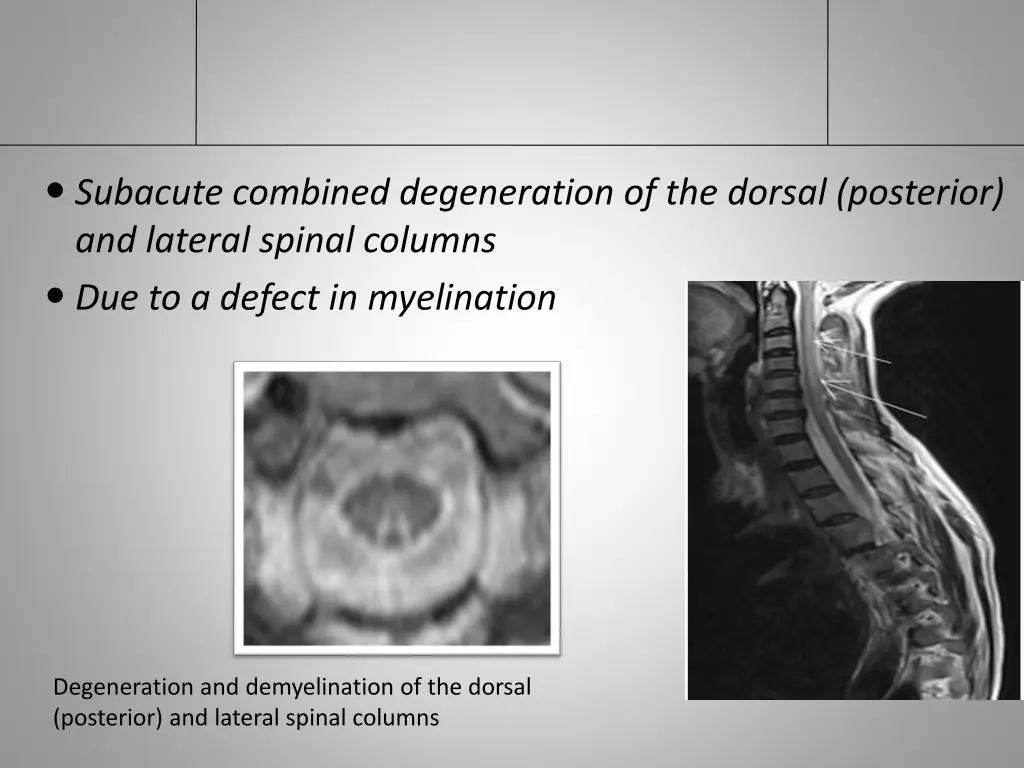 subacute combined degeneration of the dorsal