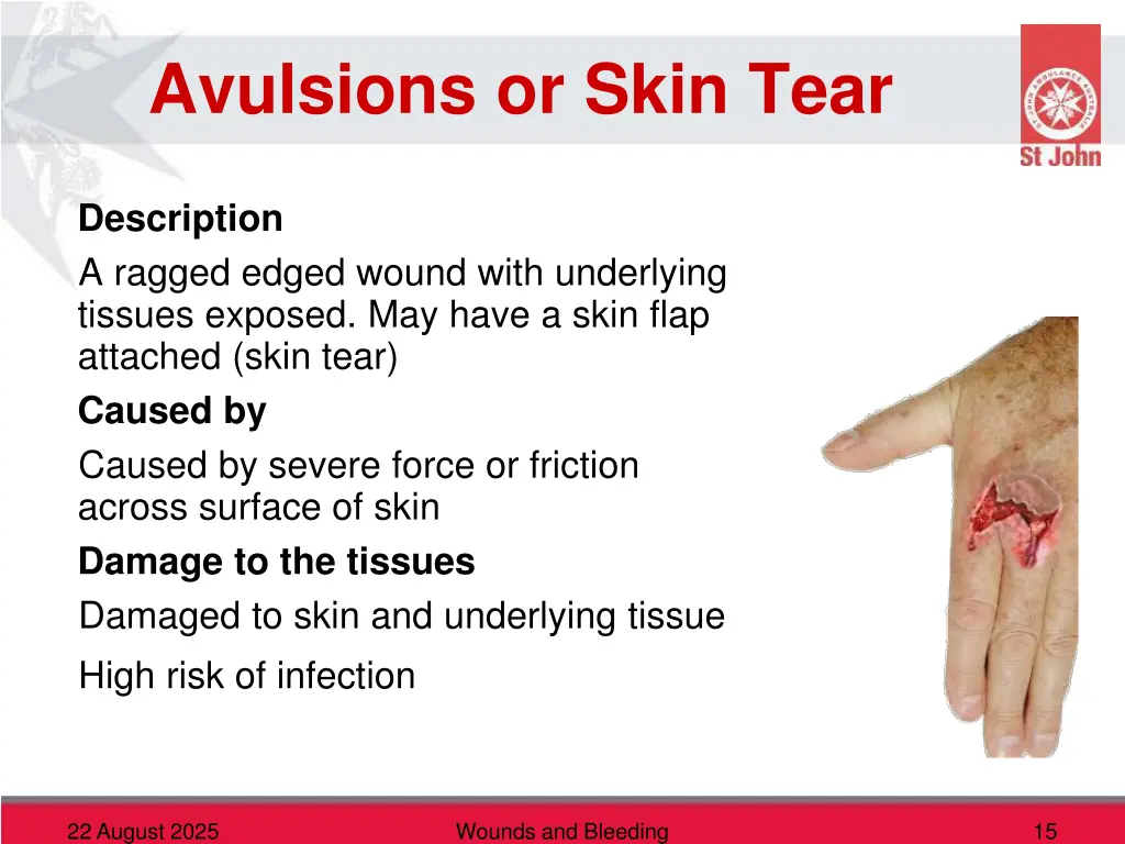 avulsions or skin tear