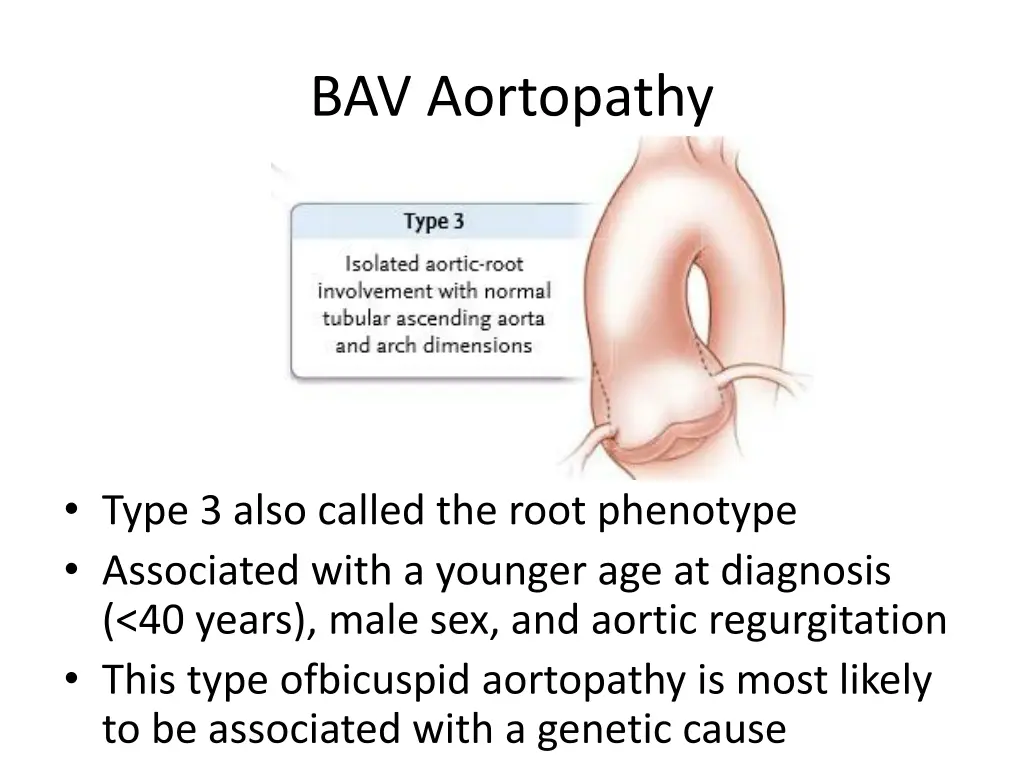 bav aortopathy 2