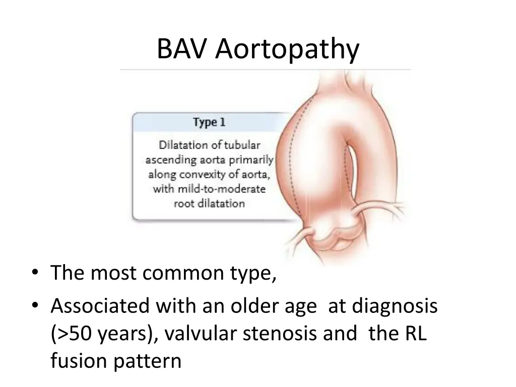 bav aortopathy