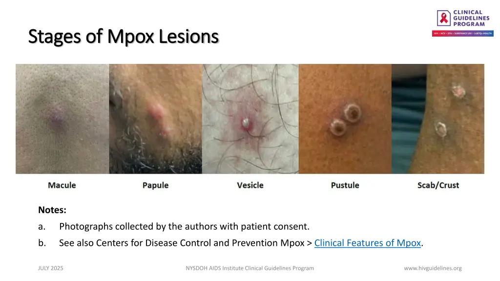 stages of stages of mpox