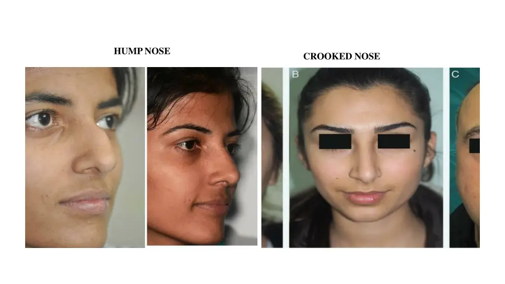 hump nose