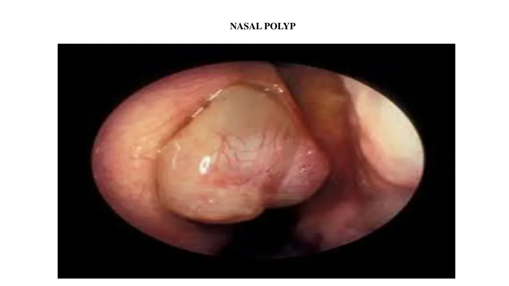 nasal polyp
