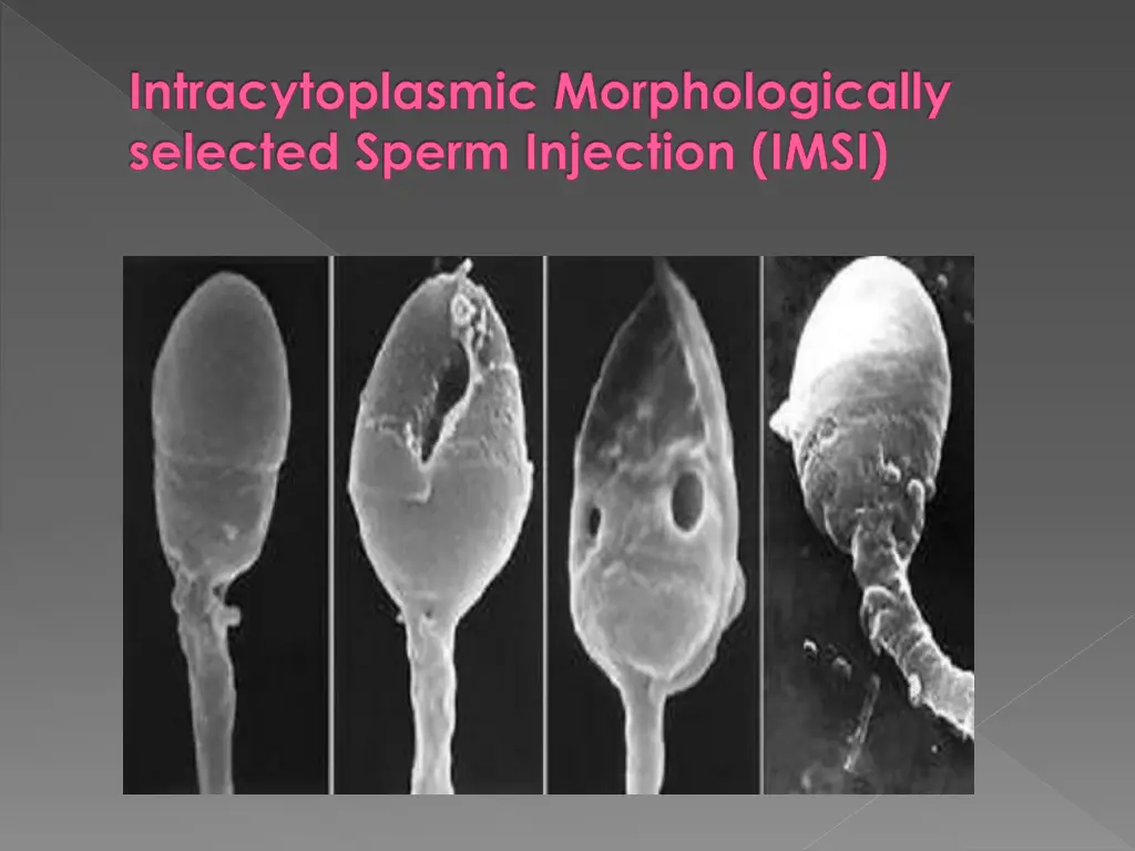 intracytoplasmic morphologically selected sperm 1