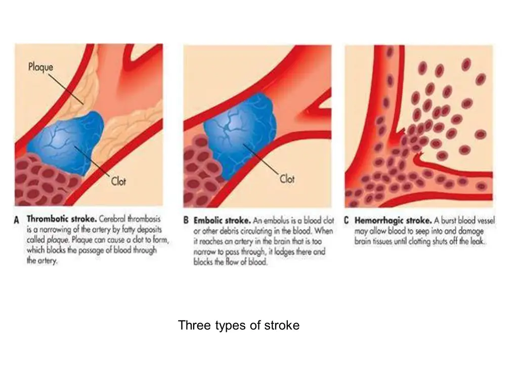 three types of stroke