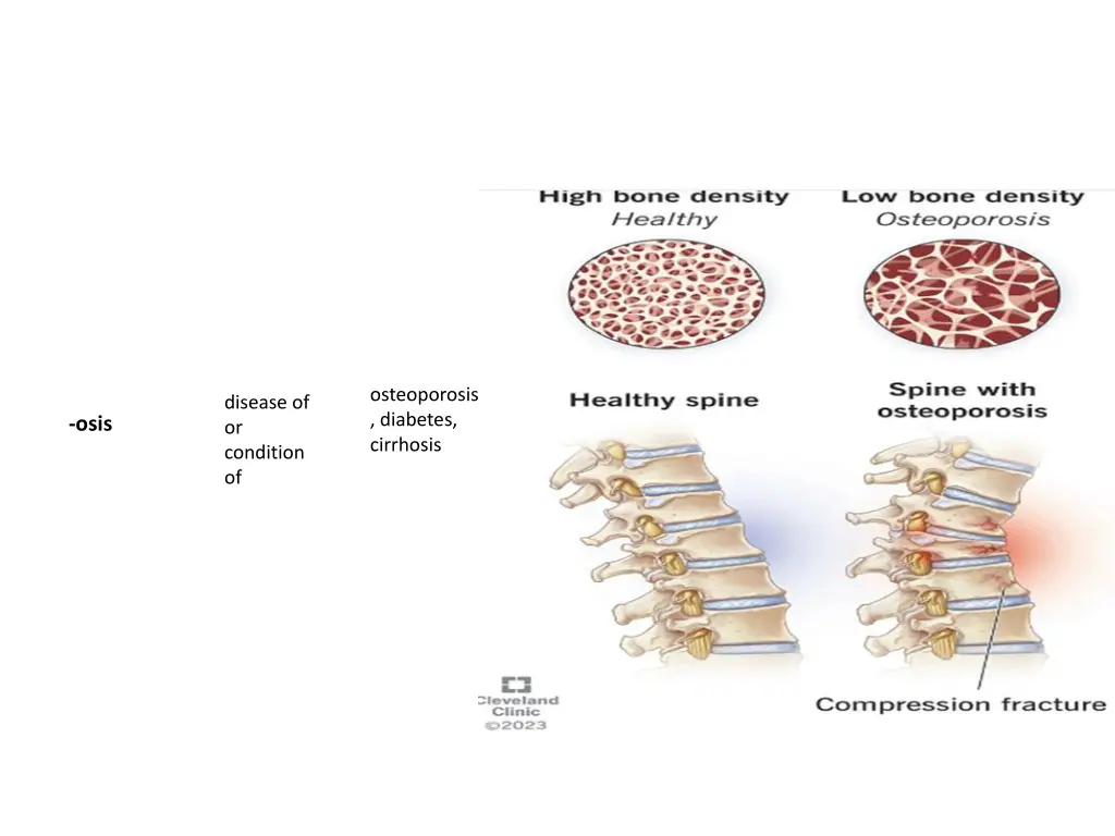 osteoporosis diabetes cirrhosis