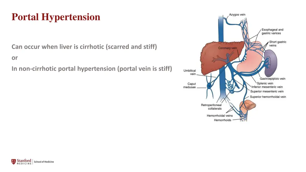 portal hypertension