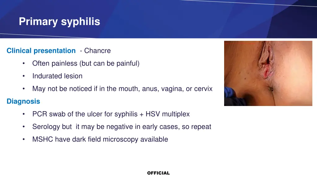 primary syphilis