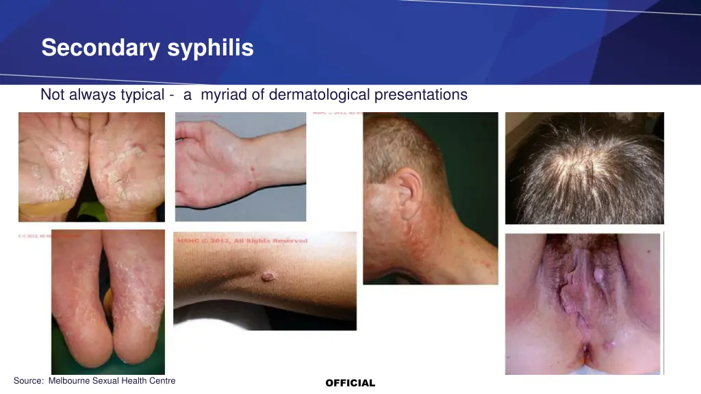 secondary syphilis