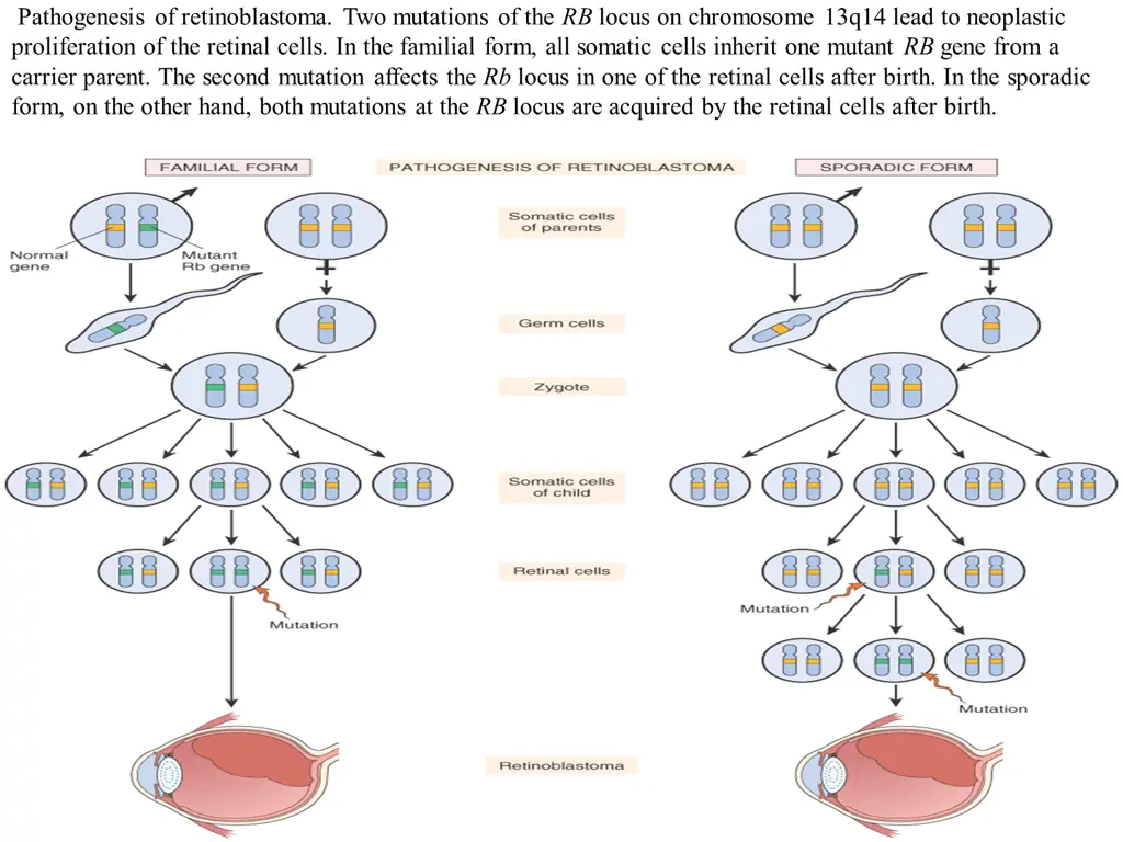 pathogenesis of retinoblastoma two mutations
