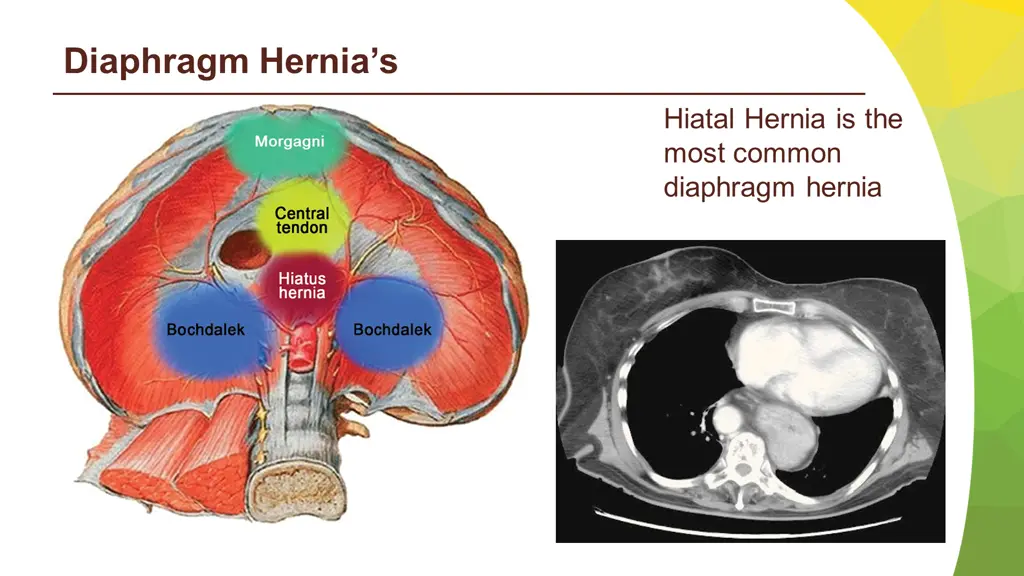 diaphragm hernia s