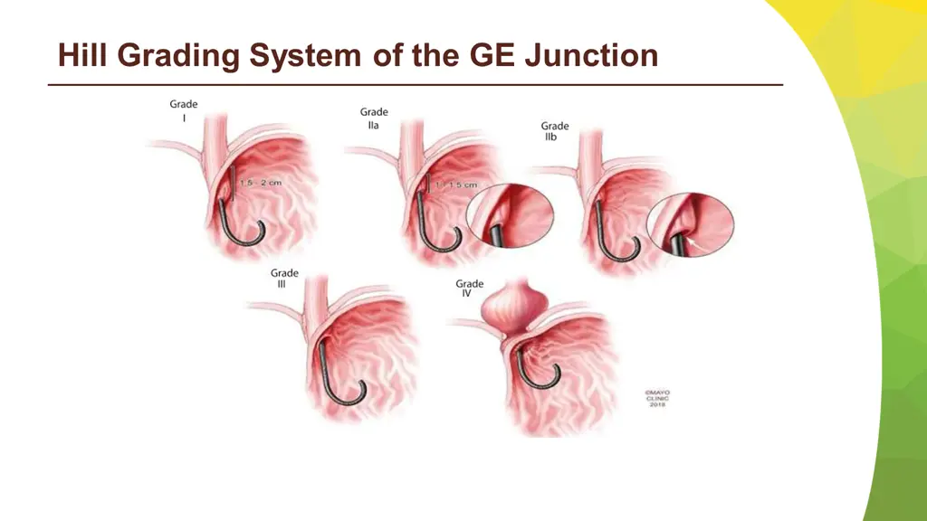 hill grading system of the ge junction