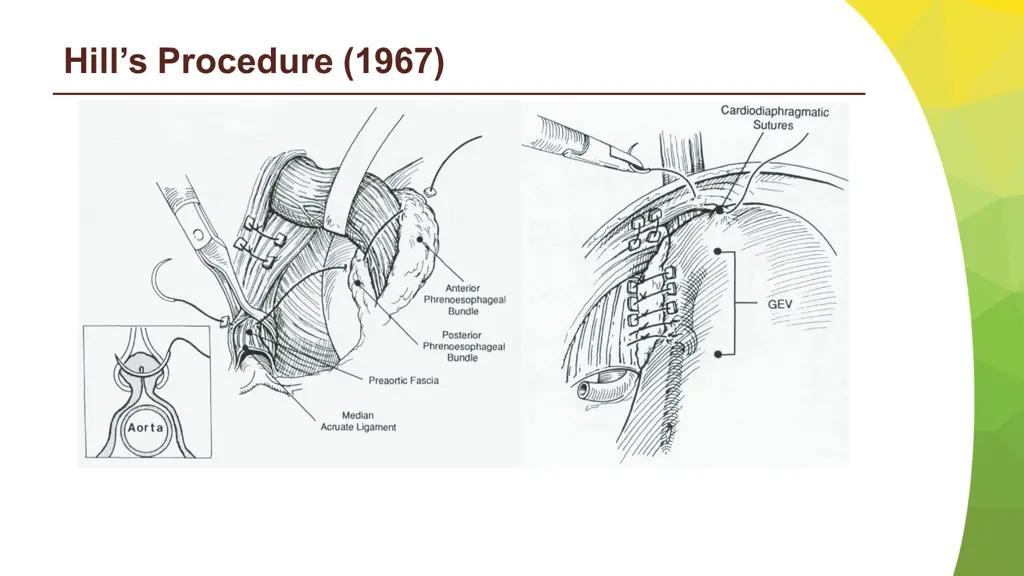 hill s procedure 1967