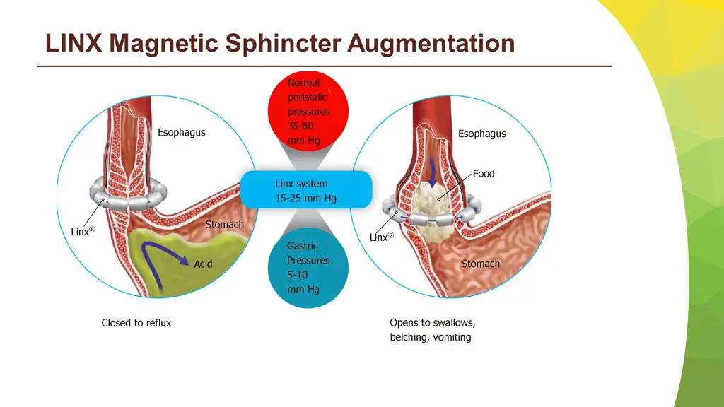 linx magnetic sphincter augmentation