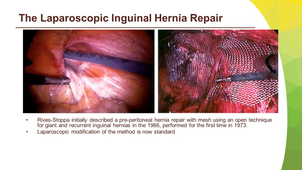 the laparoscopic inguinal hernia repair