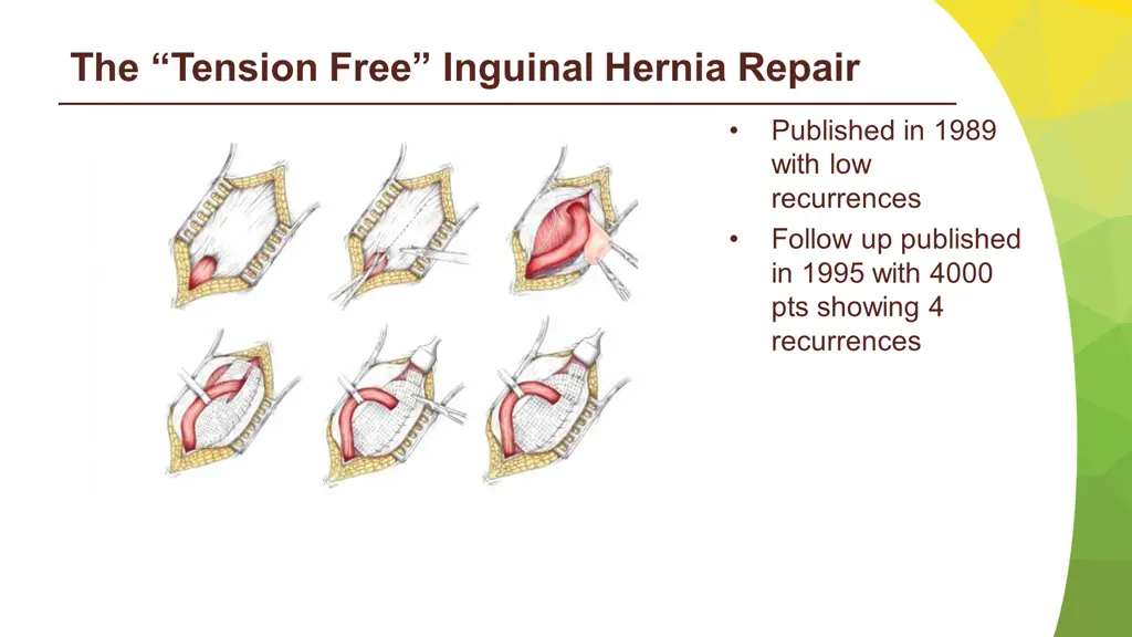 the tension free inguinal hernia repair