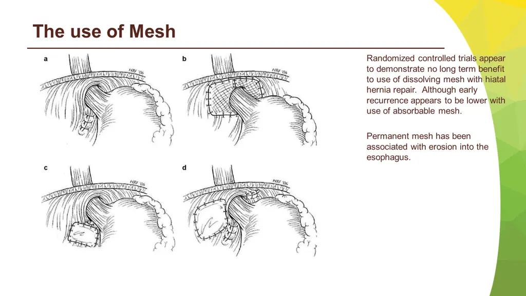 the use of mesh