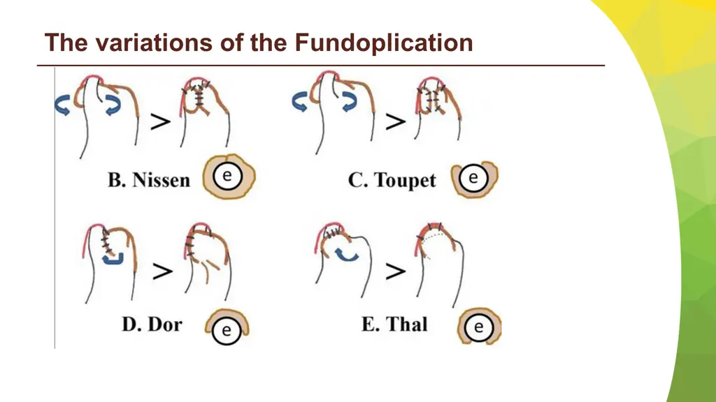 the variations of the fundoplication