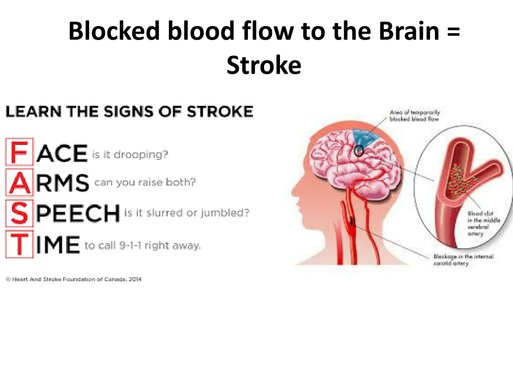 blocked blood flow to the brain stroke