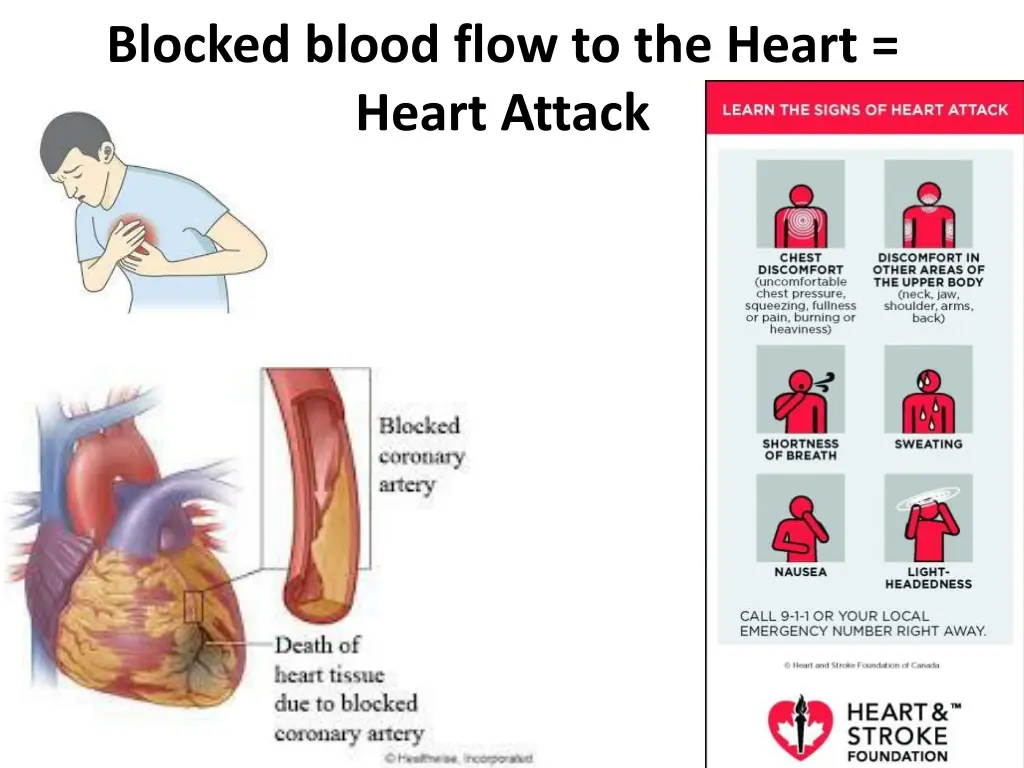 blocked blood flow to the heart heart attack