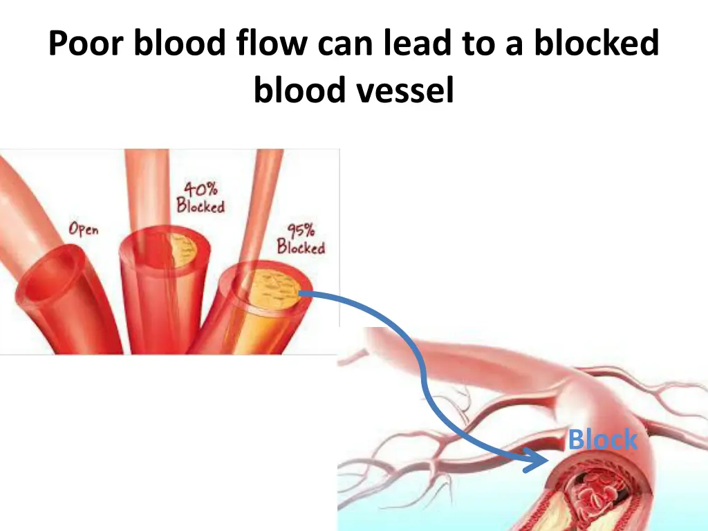poor blood flow can lead to a blocked blood vessel