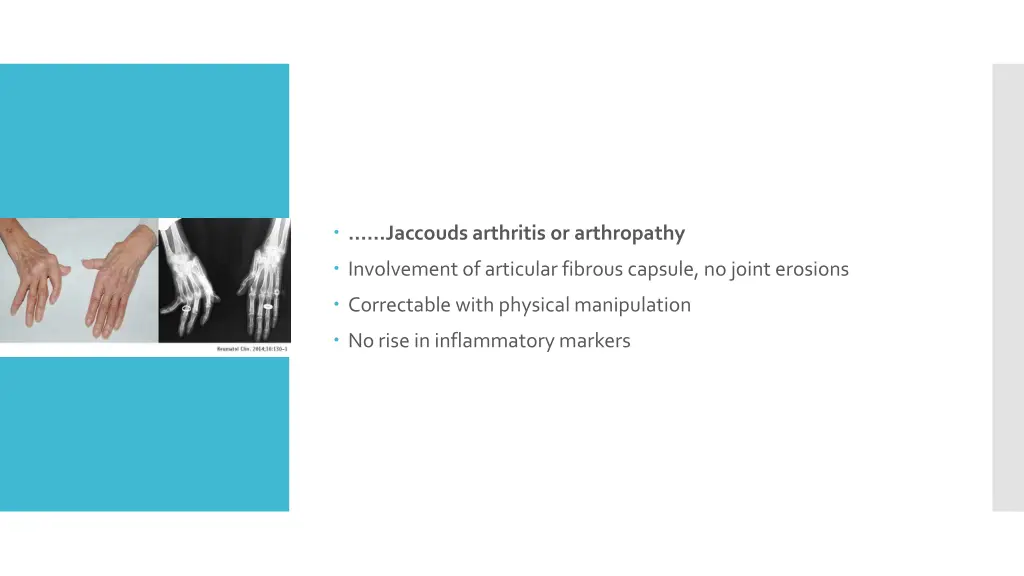 jaccoudsarthritis or arthropathy