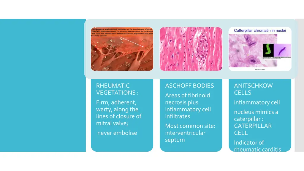 rheumatic vegetations