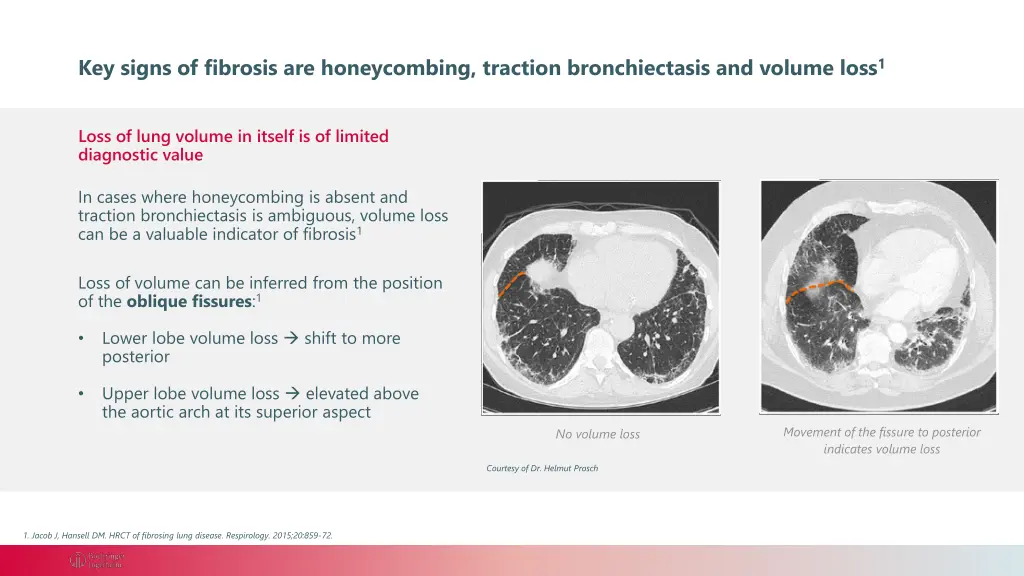 key signs of fibrosis are honeycombing traction