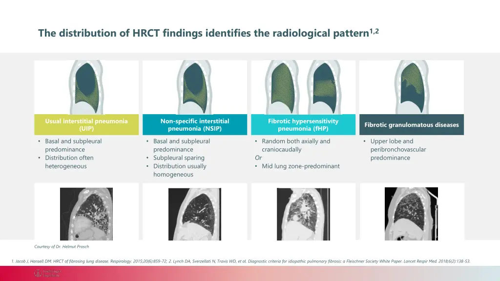 the distribution of hrct findings identifies