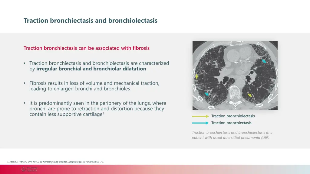 traction bronchiectasis and bronchiolectasis