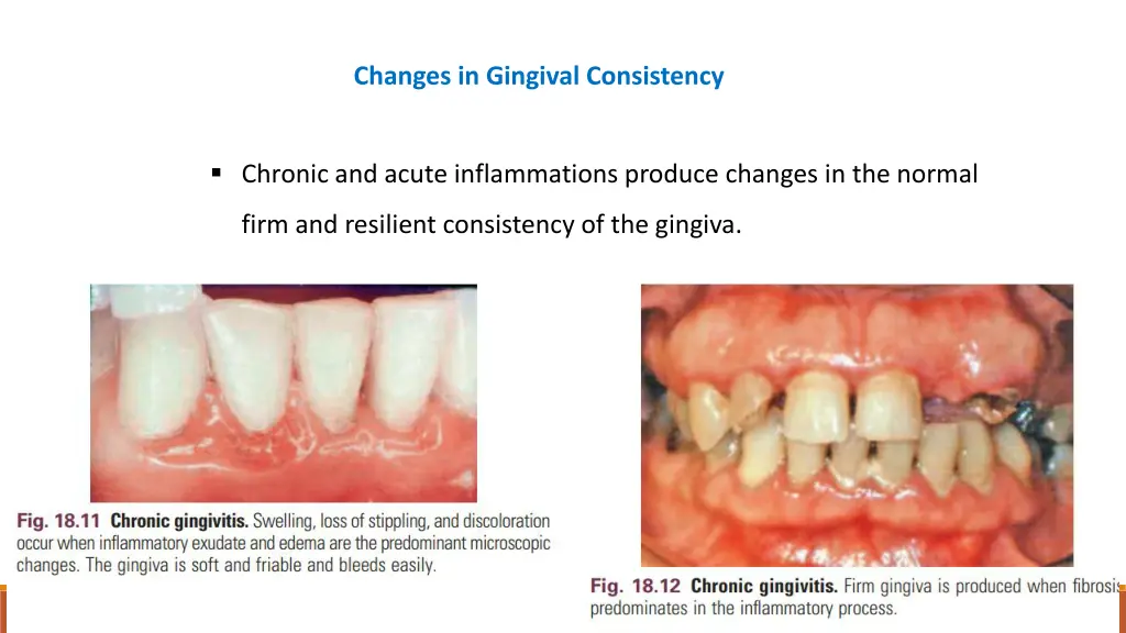 changes in gingival consistency