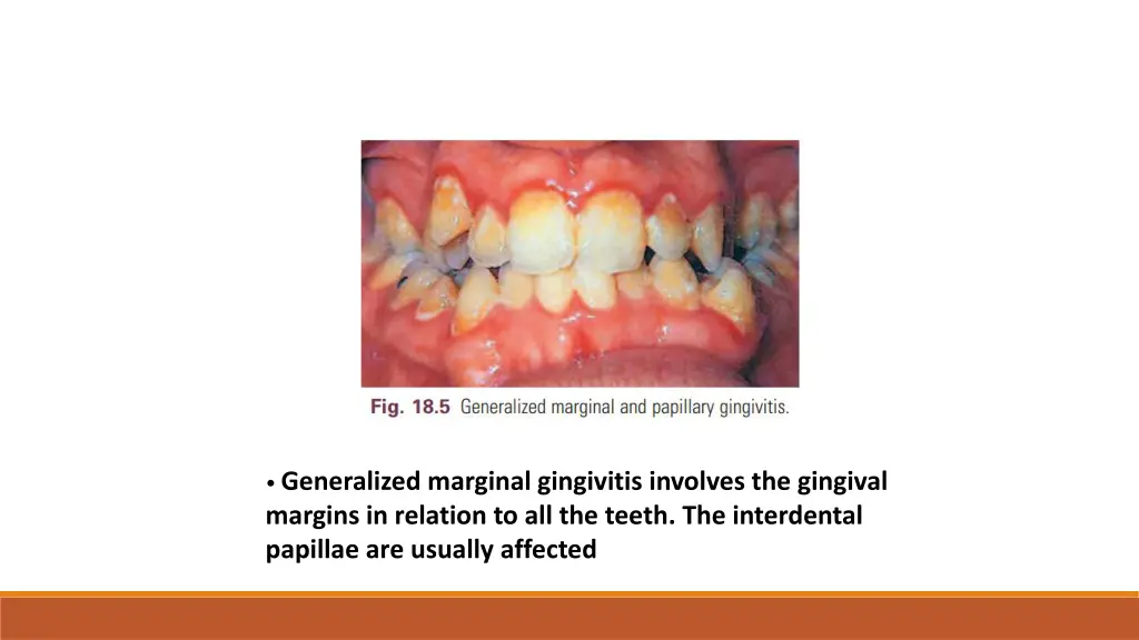 generalized marginal gingivitis involves