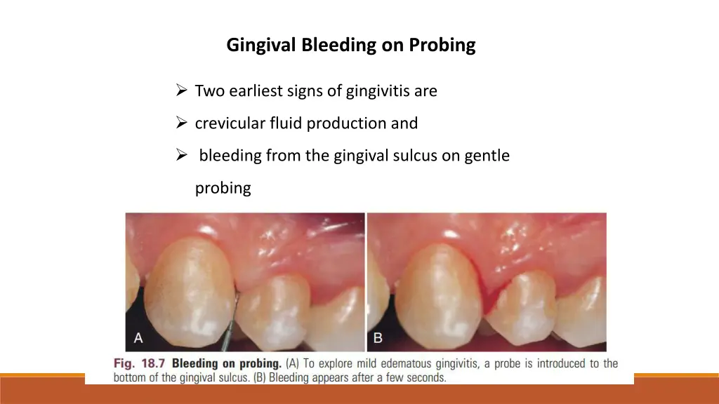 gingival bleeding on probing