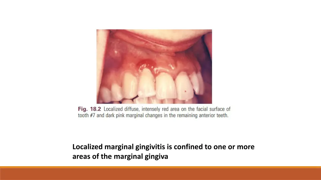 localized marginal gingivitis is confined