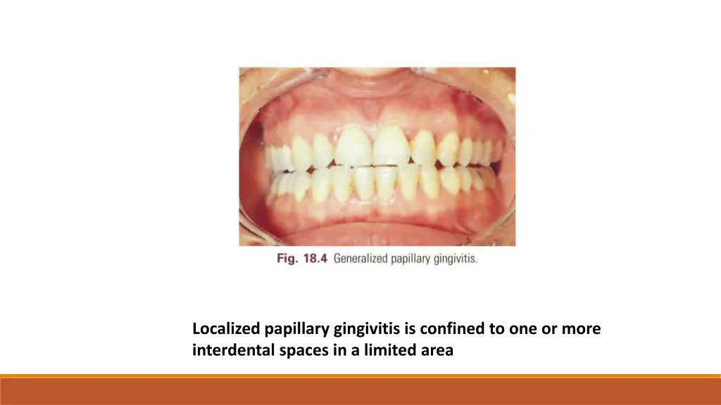 localized papillary gingivitis is confined