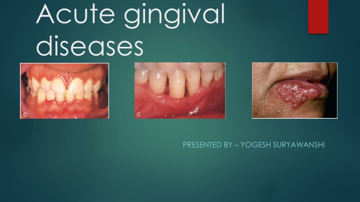 acute gingival diseases