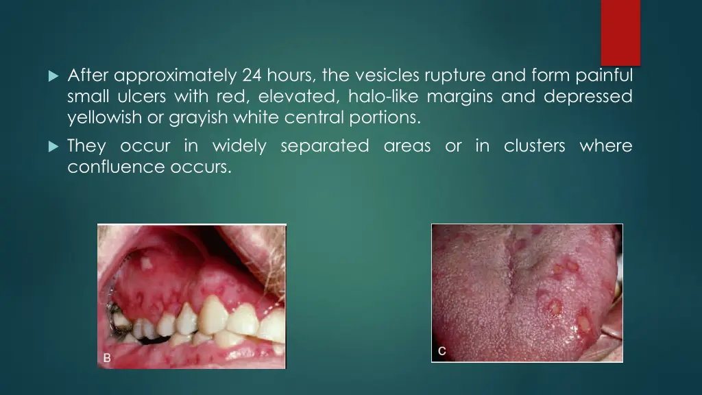 after approximately 24 hours the vesicles rupture