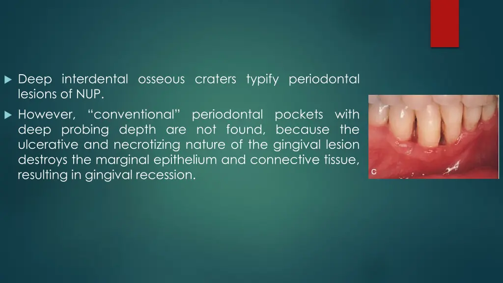 deep interdental osseous craters typify