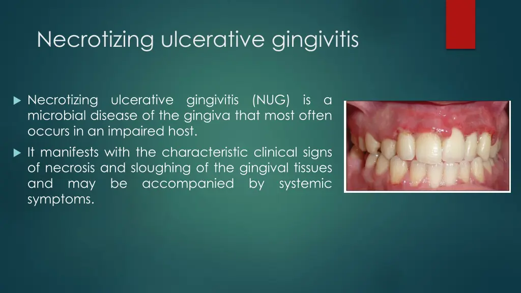 necrotizing ulcerative gingivitis