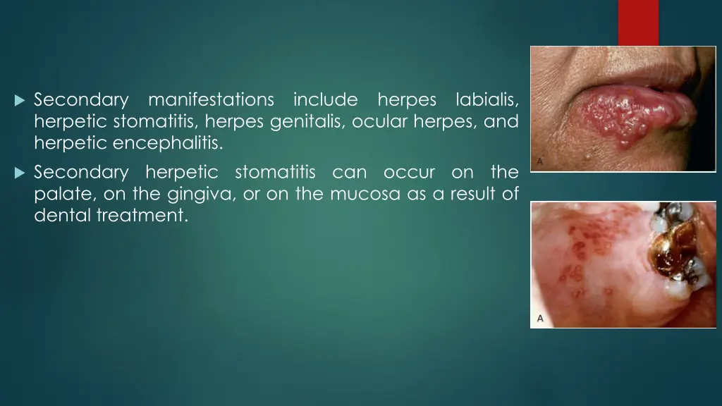 secondary manifestations include herpes labialis