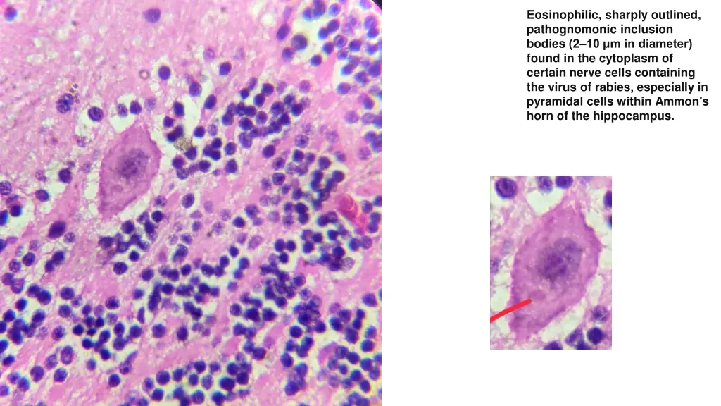 eosinophilic sharply outlined pathognomonic