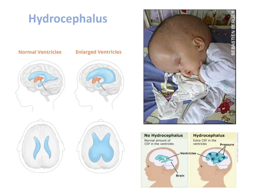 hydrocephalus