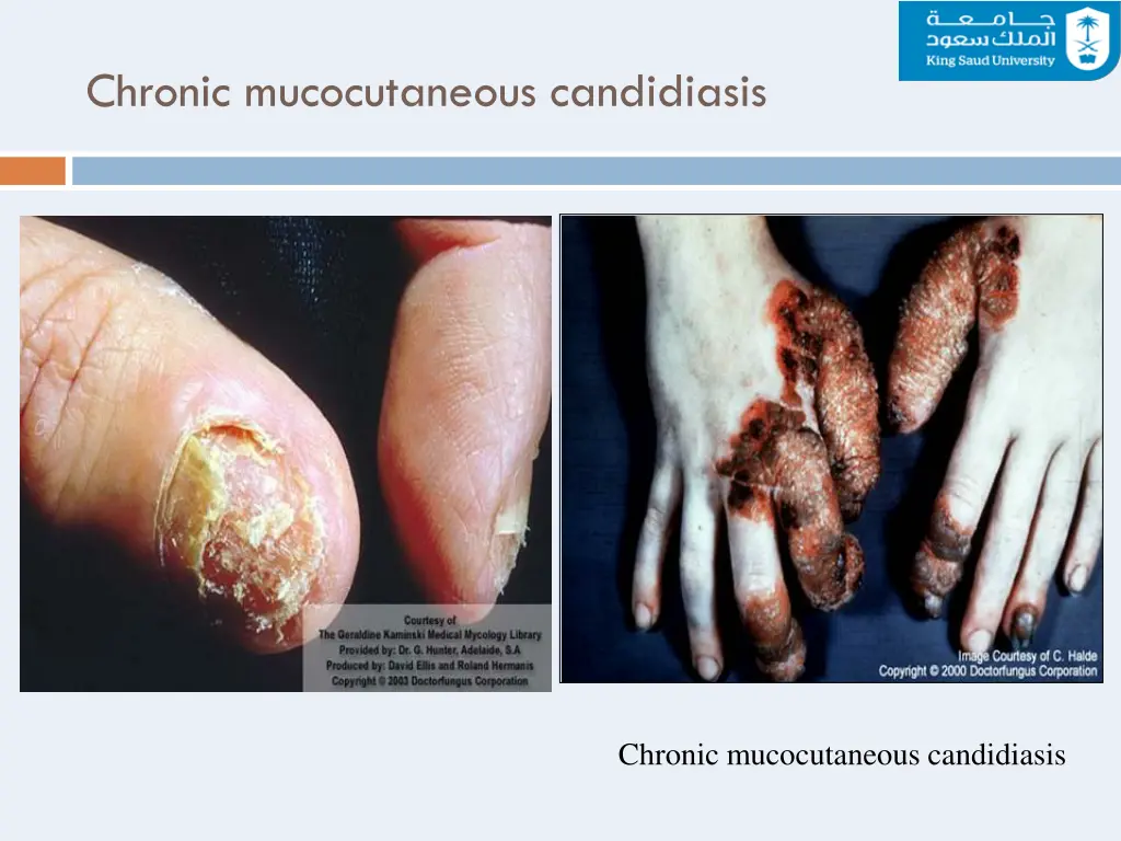 chronic mucocutaneous candidiasis