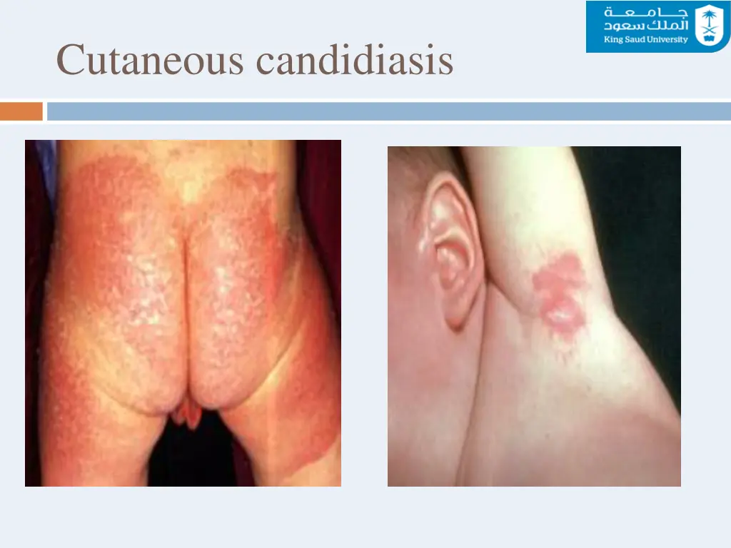 cutaneous candidiasis