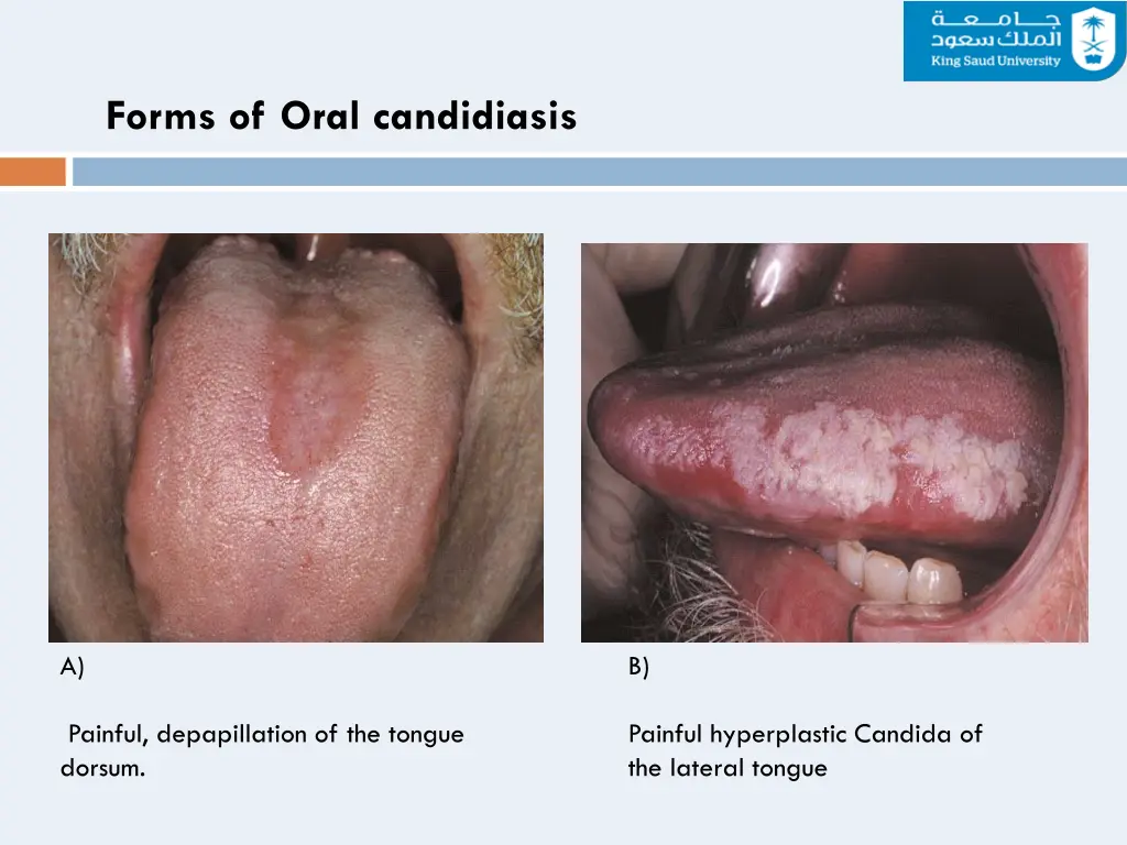 forms of oral candidiasis 1