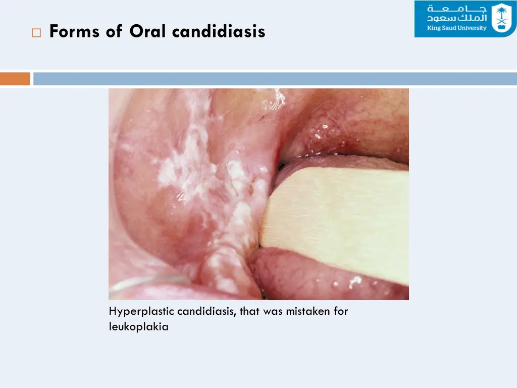 forms of oral candidiasis 2